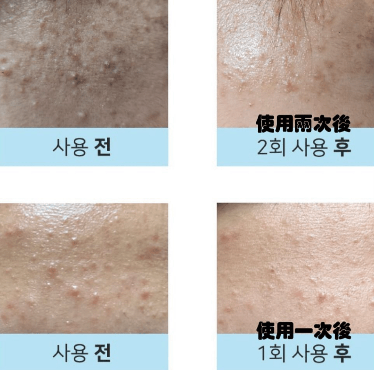 DERMATHOD O2 Tox Peel 骨針煥膚精華 30ml - La Fée Beauty