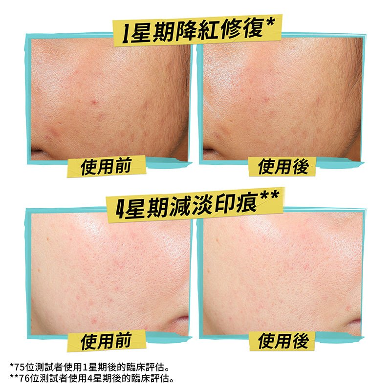 Kiehl’s 科顏氏 醫學水楊酸抗粉刺啫喱乳霜 60ml - La Fée Beauty