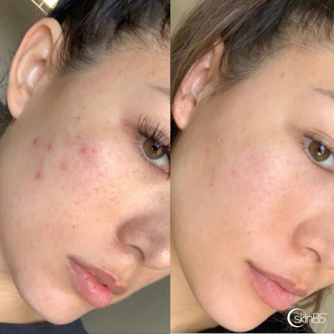 SkinB5 Extra Strength Acne Control Vitamins 特強痤瘡控製片 - La Fée Beauty