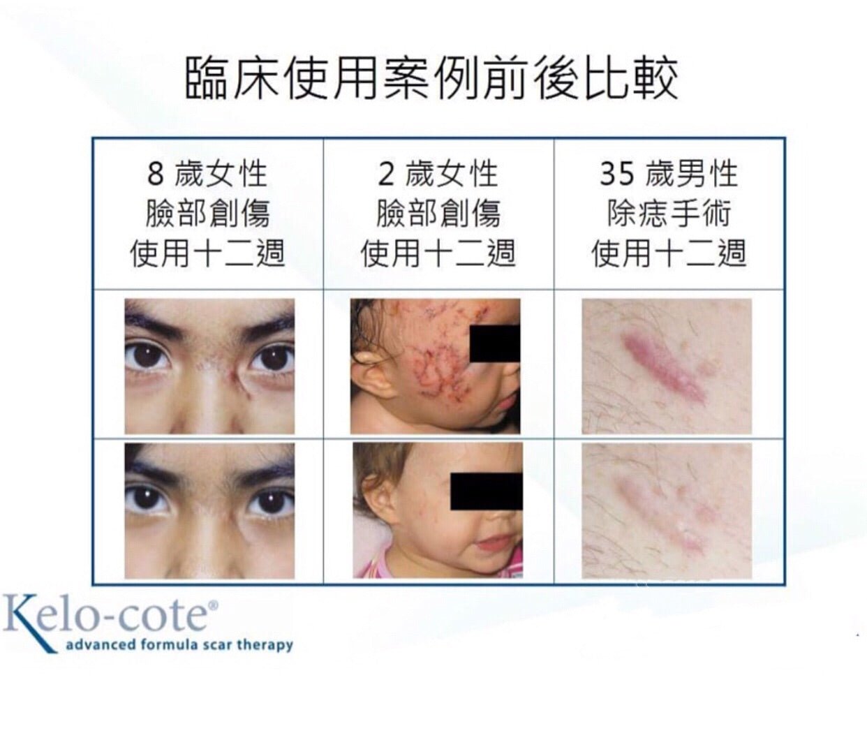 美國 進口 KELO 科特疤克矽膠軟膏 15g - La Fée Beauty