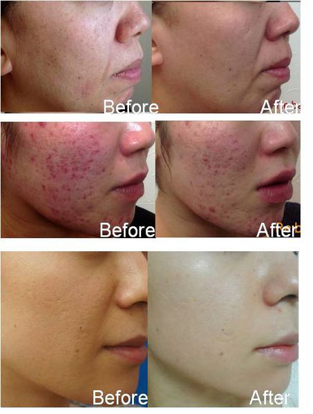 韓國 tHermoceutical - FCR 珊瑚鈣煥膚 陶瓷肌 - La Fée Beauty